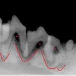 Xray before extractions